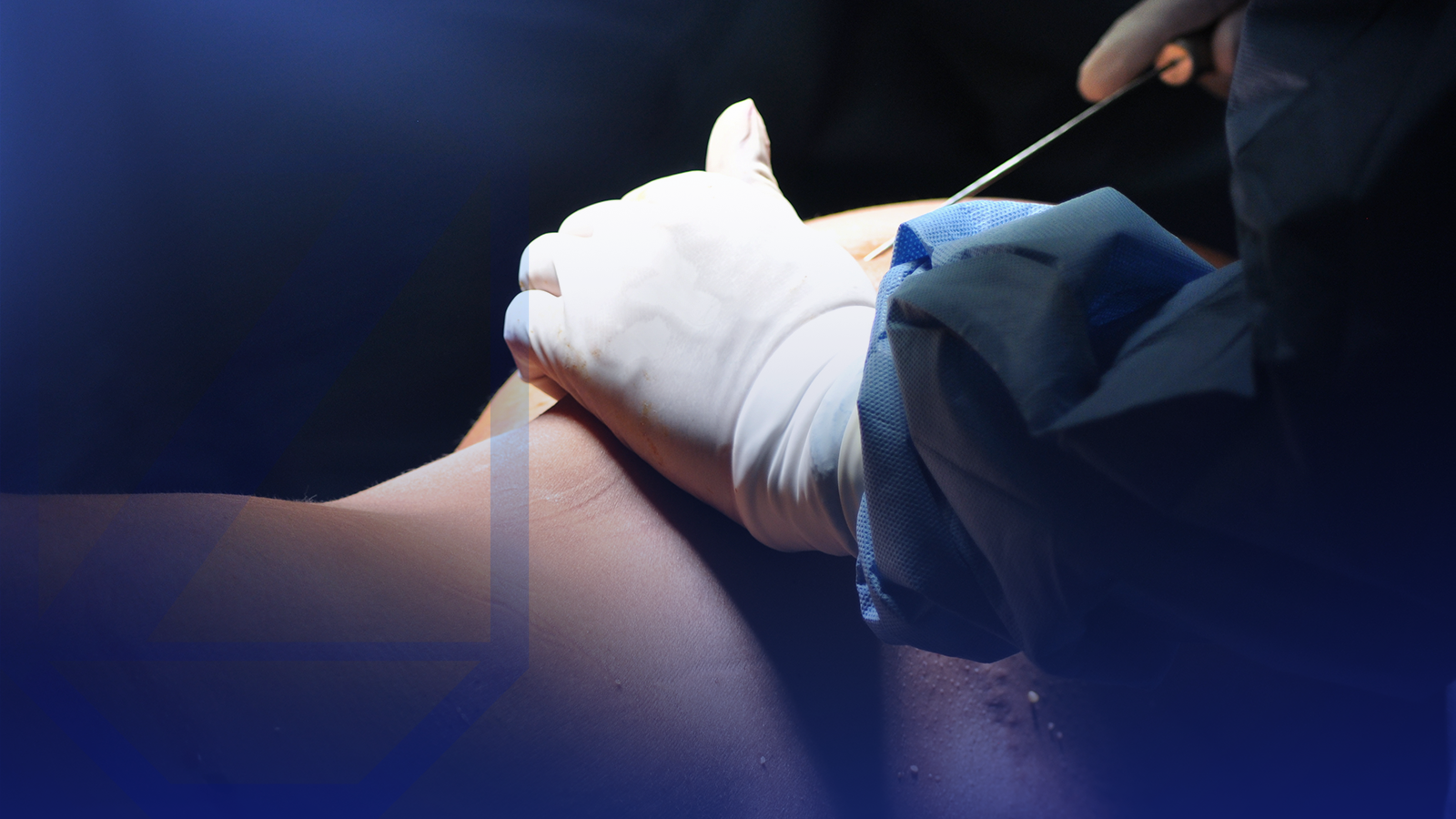 Liposucción periglútea