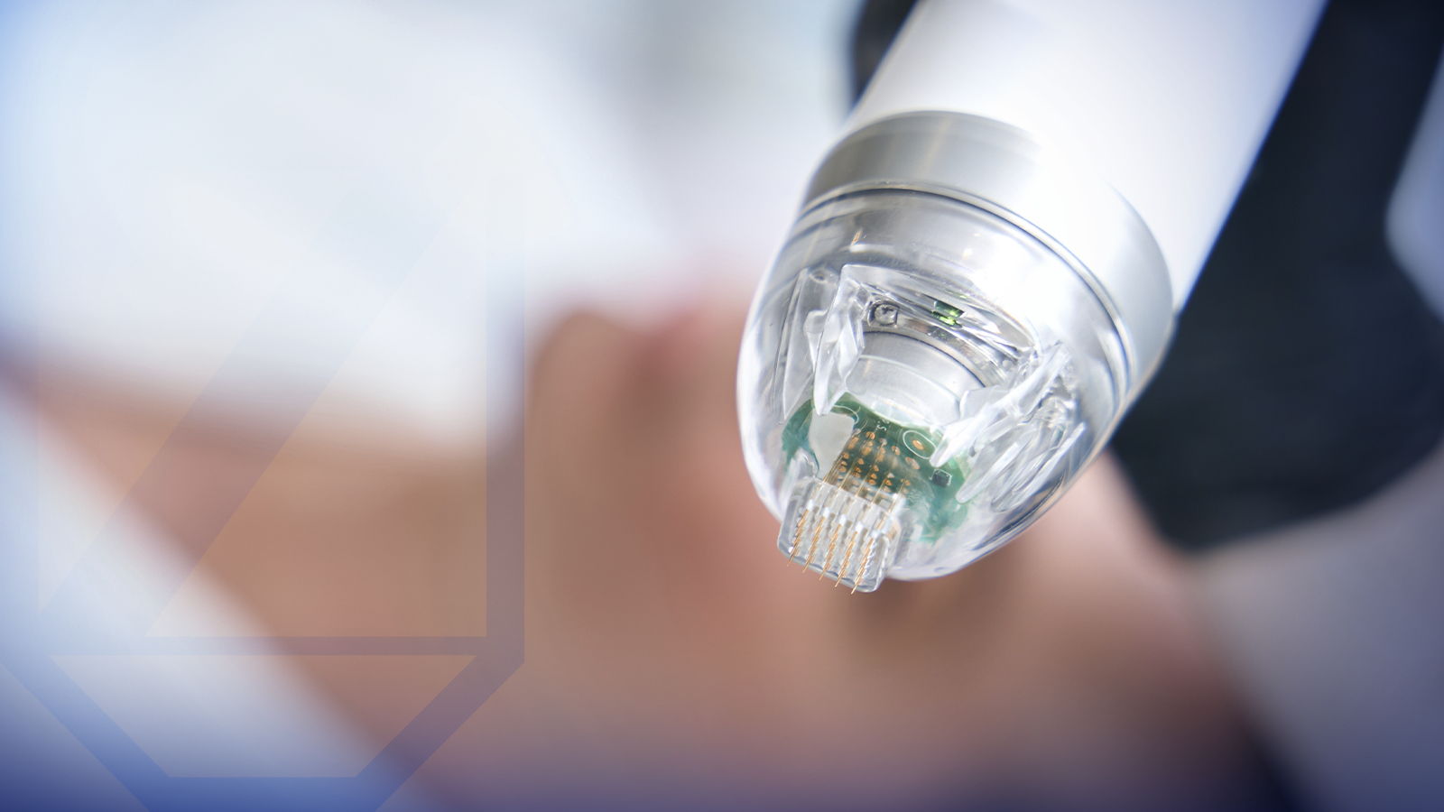 Microagujas con radiofrecuencia