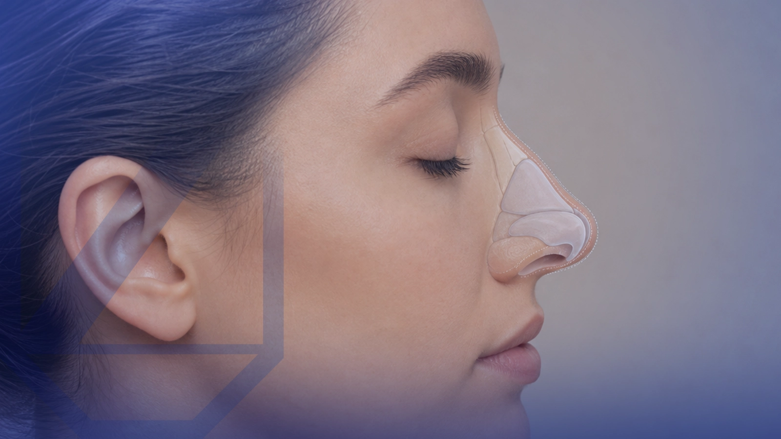 Rinoplastia